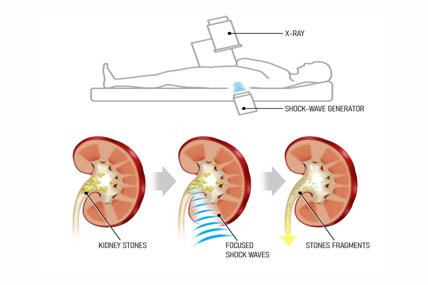 Extracorporeal Shock Wave Lithotripsy Dr Anand Arumugam Extracorporeal Shock Wave Lithotripsy Dr Anand Arumugam