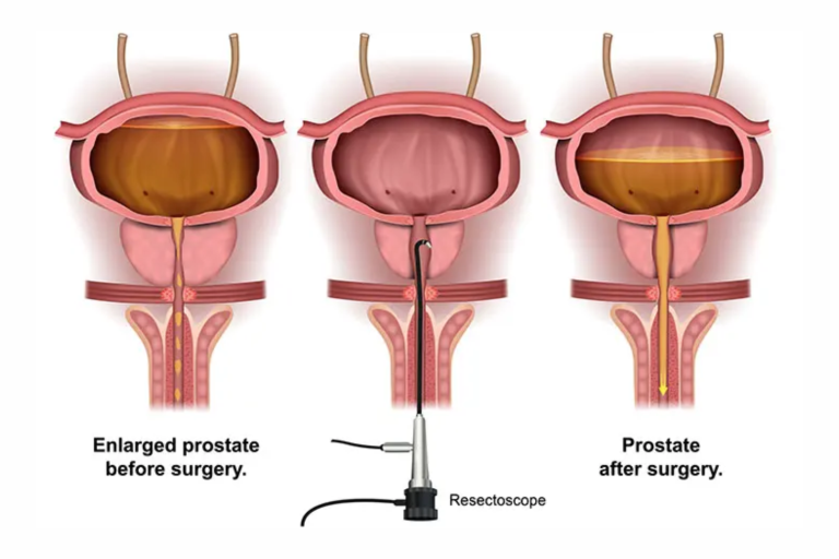 Transurethral Resection Of The Prostate Dr Anand Arumugam 0427